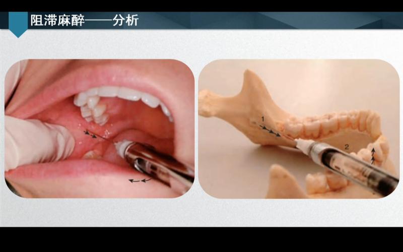 口腔各牙麻醉方法-图1