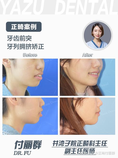 上颌前突正畸效果如何？能改善到什么程度？-图2
