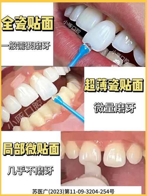 临时牙贴面的制作方法是什么？步骤有哪些？-图1
