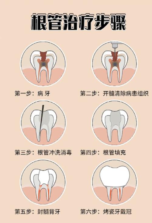 牙齿根尖治疗方法如何有效选择？-图2