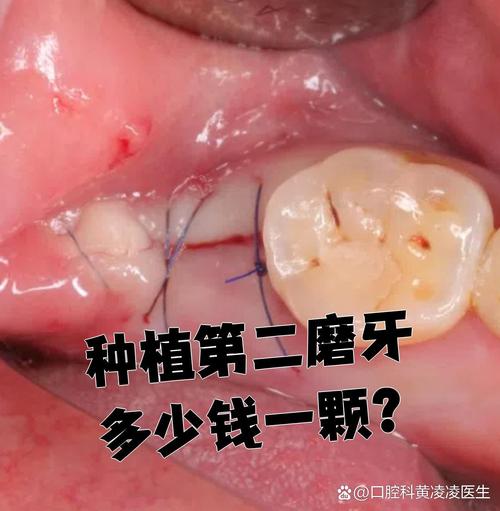 一个牙钉种两棵牙？这种种植技术可行吗？-图2