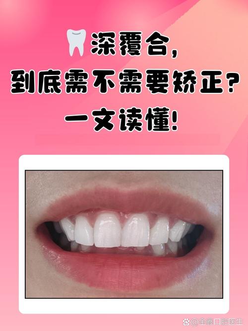 咬合深覆正畸遭拒,医生为何持反对态度?-图1 咬合深覆正畸遭拒,医生为何持反对态度?-图1