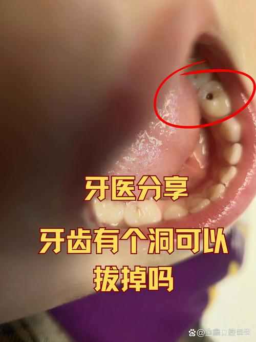 牙洞最佳补救方法是什么？哪种最有效？-图2