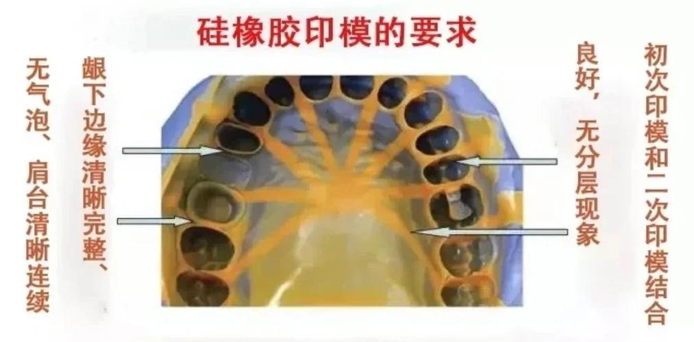 口腔硅胶取模的正确方法步骤是怎样的？-图3