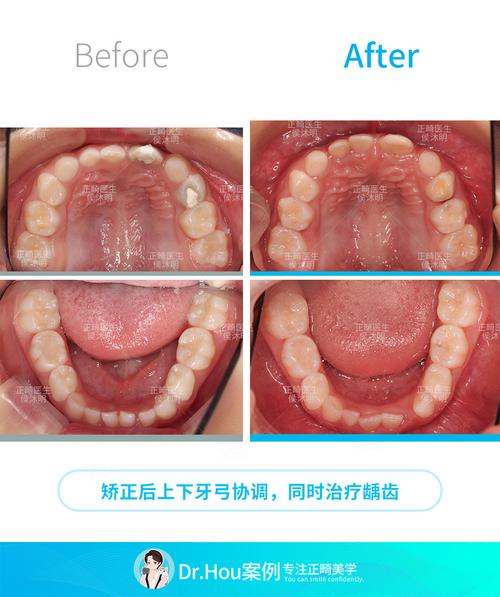 儿童前牙反颌正畸的最佳矫治时机是什么时候？-图1