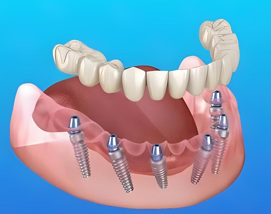 2025种一颗牙，这些新趋势你准备好了吗？-图3