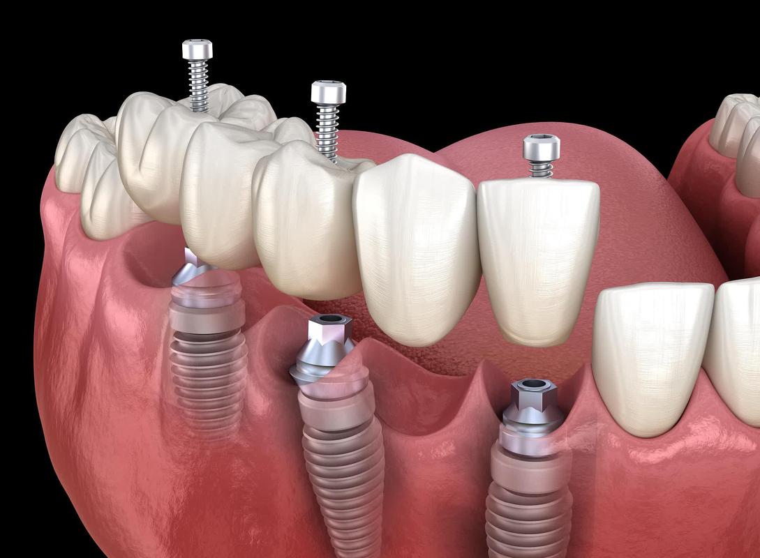 2025种一颗牙，这些新趋势你准备好了吗？-图1