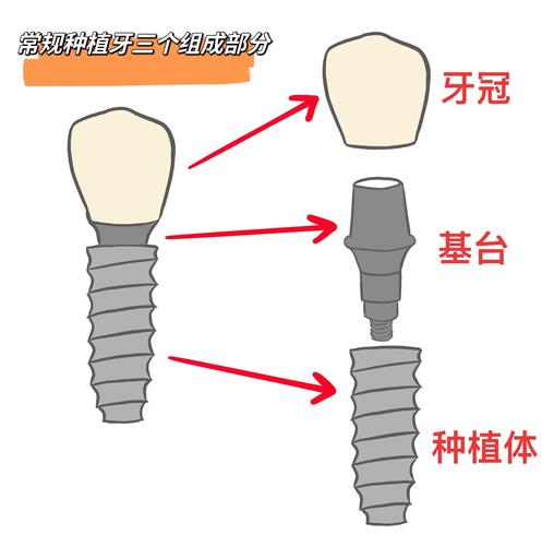 种牙选牙齿，材质、品牌、效果怎么选？-图1
