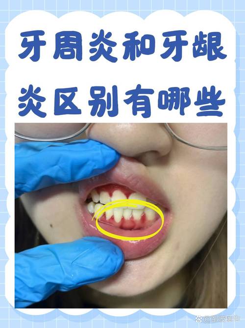 牙周炎患者做正畸治疗会有什么后果？-图1