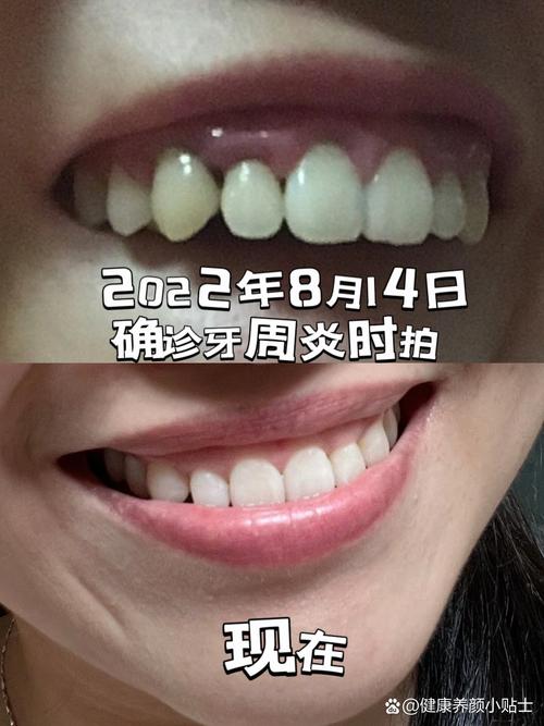 牙周炎患者做正畸治疗会有什么后果？-图3