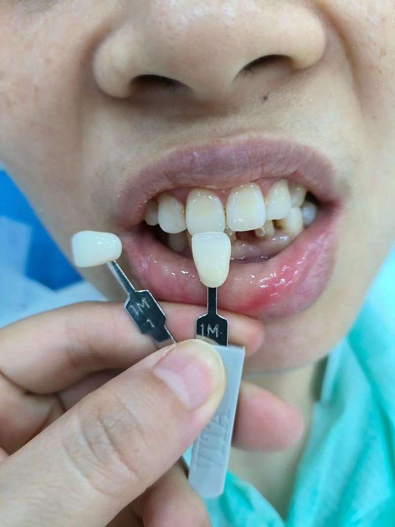 冠延长术后，种植牙修复是否还能顺利进行？-图3