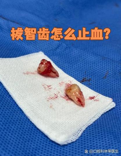 拔牙后一直流血?快速止血方法有哪些?-图2 拔牙后一直流血?快速止血方法有哪些?-图2
