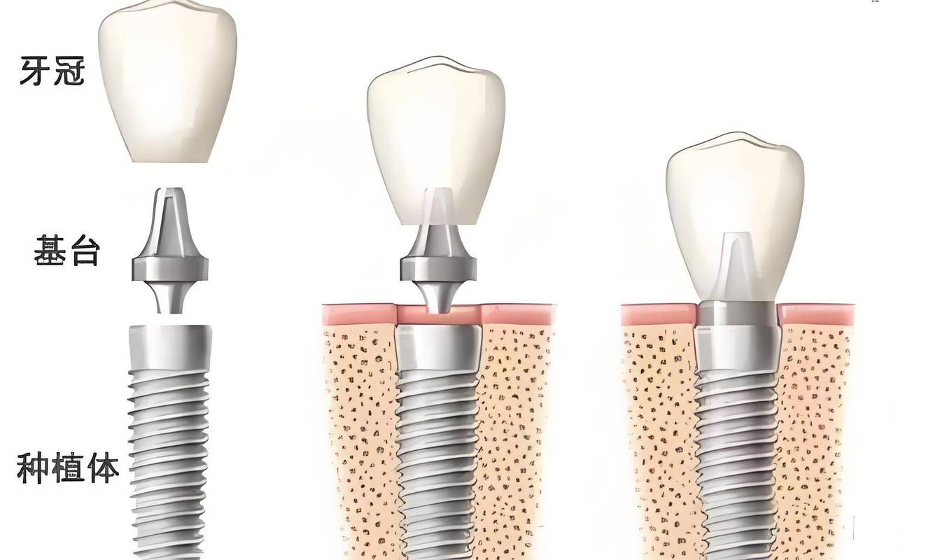 要种20颗种植牙-图1 要种20颗种植牙-图1