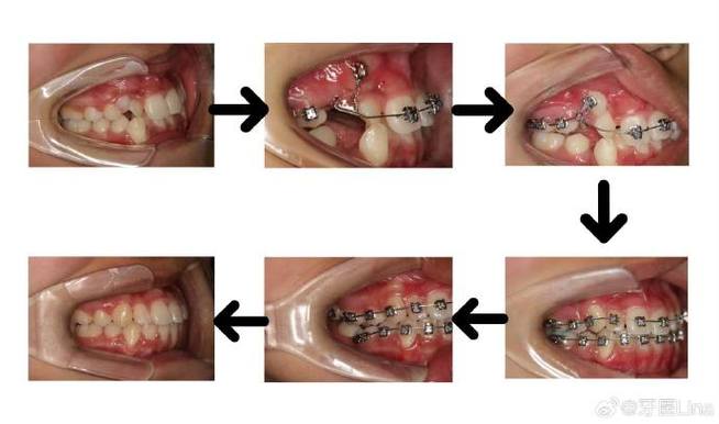 正畸牵引勾放置位置有何讲究？-图3