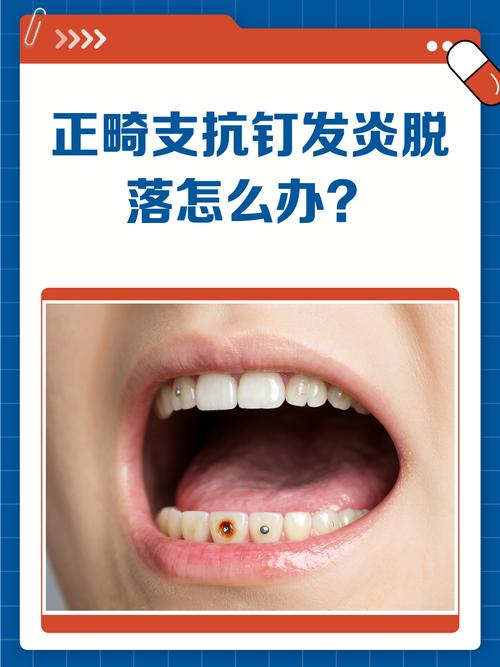 正畸种植钉脱落，常见原因究竟有哪些呢？-图2