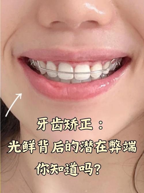 种牙后还能做矫正吗?对种植牙有影响吗?-图1 种牙后还能做矫正吗?对种植牙有影响吗?-图1