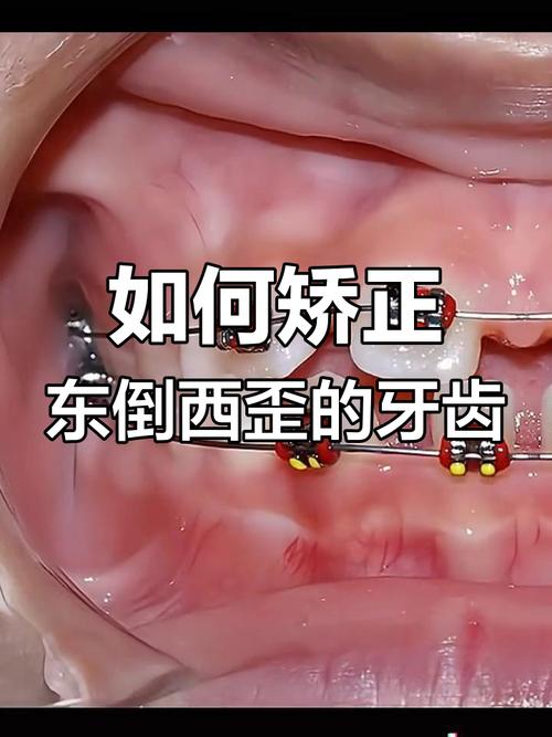 切牙反颌正畸方法有哪些具体选择?-图3 切牙反颌正畸方法有哪些具体选择?-图3