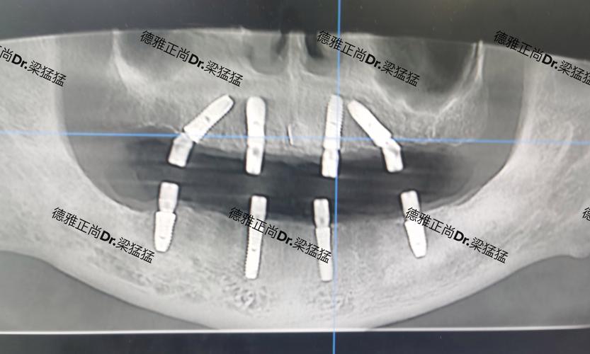美奥口腔种牙周期一般需要多久？-图2