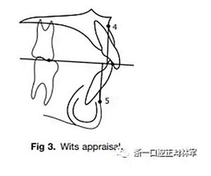正畸Wits值正常值具体范围是多少？-图1