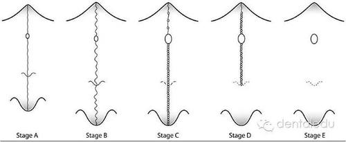 腭中缝扩展的方法有哪些及如何操作？-图1