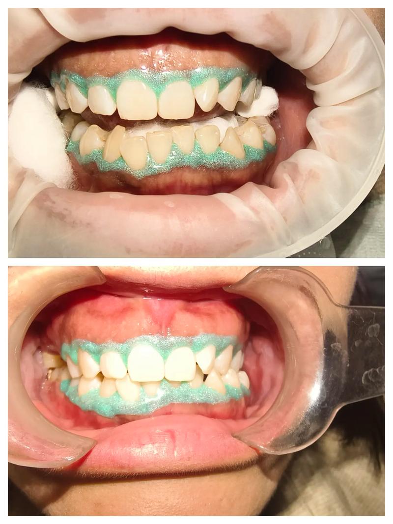 牙齿美白方法对比，哪种最有效又安全？-图1