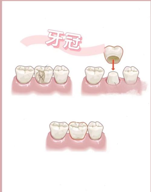 牙齿嵌体修复的方法具体有哪些步骤？-图1