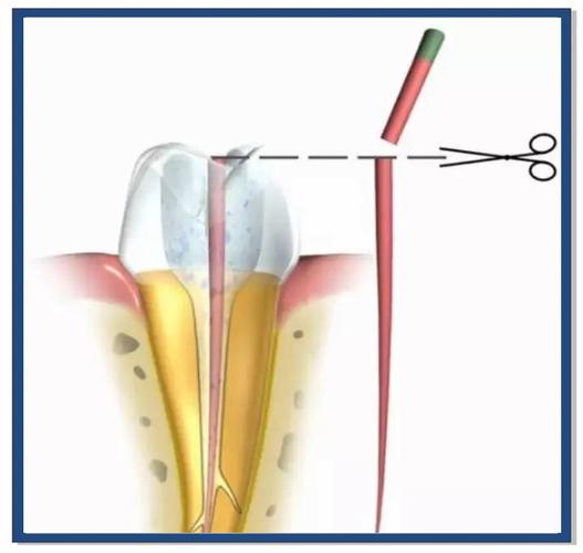 牙尖治疗方法有哪些?如何有效治疗牙尖问题?-图3 牙尖治疗方法有哪些?如何有效治疗牙尖问题?-图3