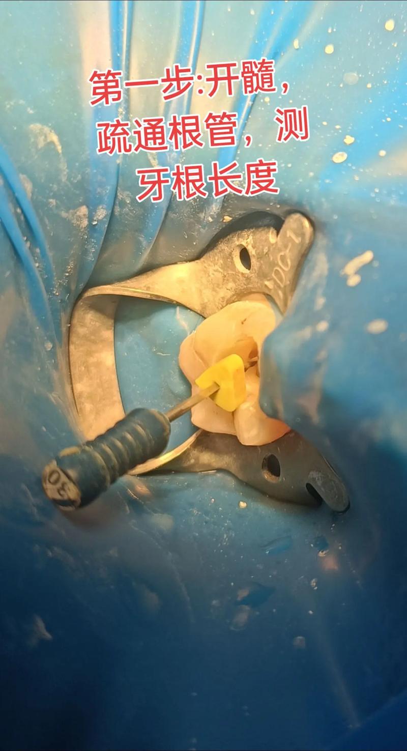 根管堵塞疏通方法-图2