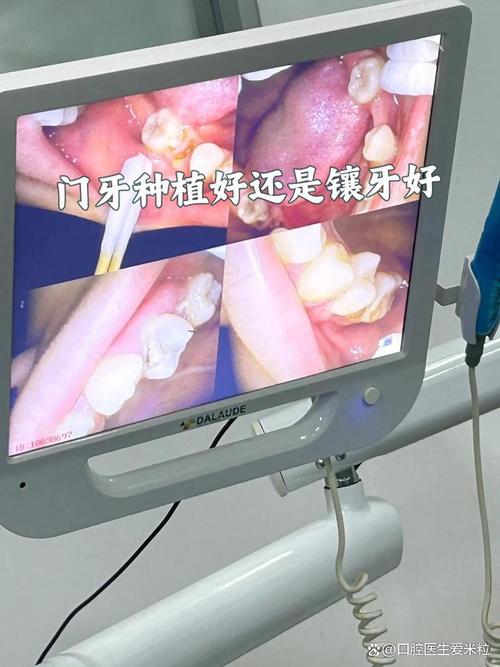 什么是水激光种牙?与传统种牙有何区别?-图3 什么是水激光种牙?与传统种牙有何区别?-图3