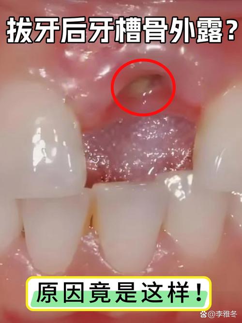 月经期能拔正畸牙吗?有哪些注意事项?-图3 月经期能拔正畸牙吗?有哪些注意事项?-图3