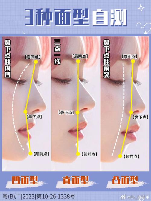 正畸侧貌面型分类标准-图2 正畸侧貌面型分类标准-图2