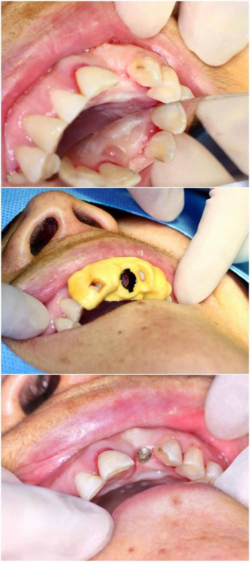石家庄省医院种牙效果如何?价格贵不贵?-图3 石家庄省医院种牙效果如何?价格贵不贵?-图3