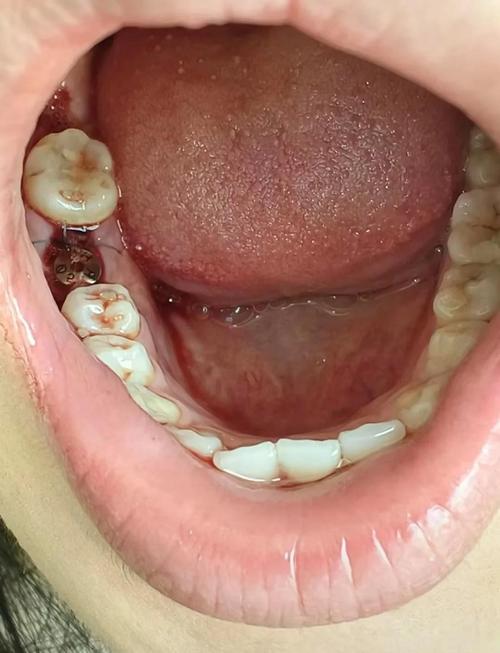 种牙后牙龈形态影响美观，该如何改善？-图2