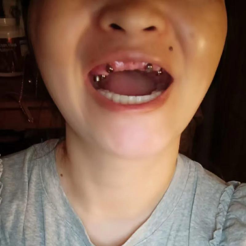 种牙后牙龈形态影响美观，该如何改善？-图1