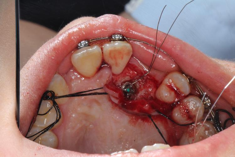 尖牙埋伏阻生正畸牵引如何有效牵引?-图2 尖牙埋伏阻生正畸牵引如何有效牵引?-图2