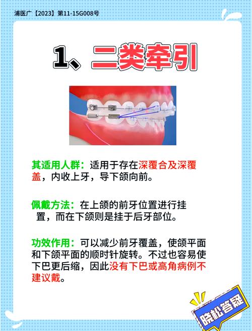 内倾牙齿矫正方法有哪些？如何选择适合的？-图3