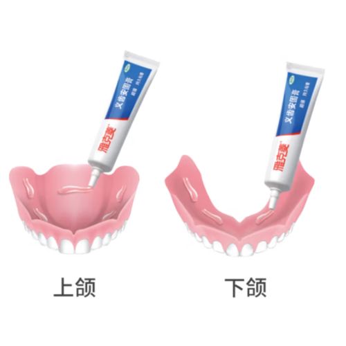 正畸中咬合面粘胶对牙齿移动有何影响?-图2 正畸中咬合面粘胶对牙齿移动有何影响?-图2