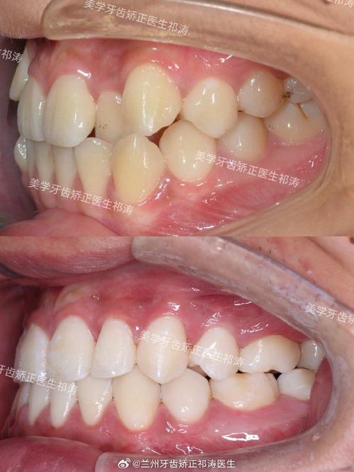 种牙后其他牙齿为何会拥挤？是邻牙移位还是种植体影响？-图3