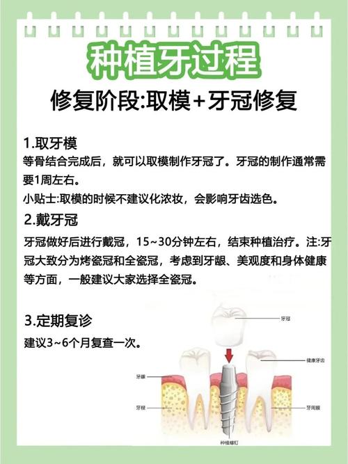 种牙手术到底要做几次？不同情况次数一样吗？-图1