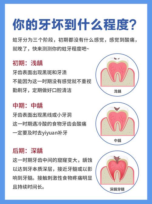成人龋齿如何彻底根治？有哪些有效治疗手段？-图1