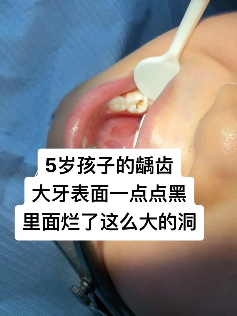 蛀牙发黑怎么办?有哪些有效的处理方法?-图2 蛀牙发黑怎么办?有哪些有效的处理方法?-图2