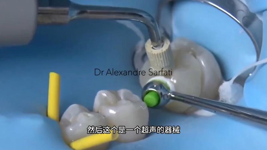 树脂嵌体粘接方法的关键步骤有哪些？-图1