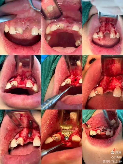 种牙感染的原因、症状及应对措施有哪些？-图2