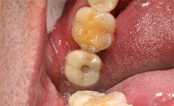 种牙感染的原因、症状及应对措施有哪些？-图3