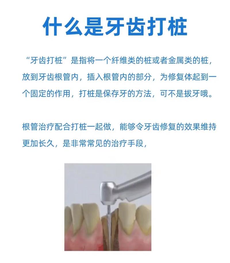 补牙打桩操作方法-图1