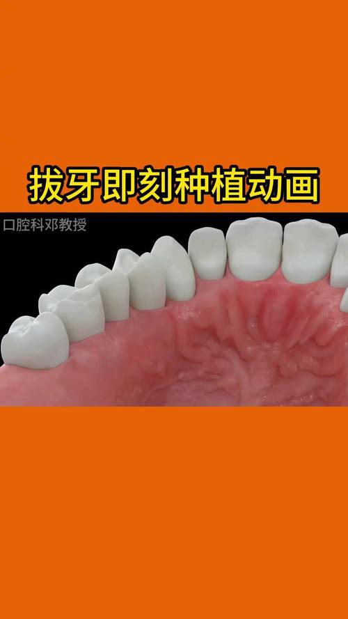 拔牙科能做种植牙吗？种植牙效果如何？-图1