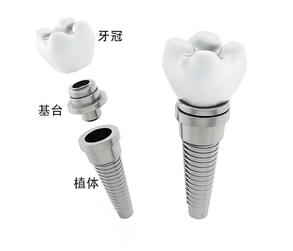 复合基台种植方法如何规范操作与选择？-图1