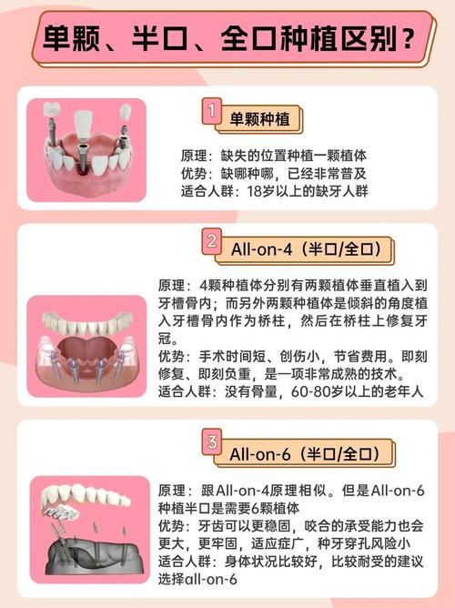 种植全口牙一般需要多长时间完成种植修复？-图3