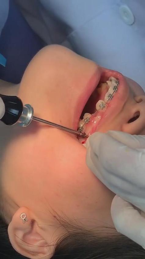 正畸上前牙种植钉的最佳位置如何确定？-图1