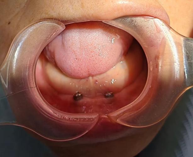 种牙难度大的案例，究竟难在哪些关键环节？-图1